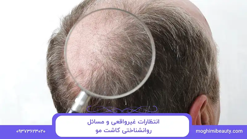 انتظارات غیرواقعی و مسائل روانشناختی کاشت مو