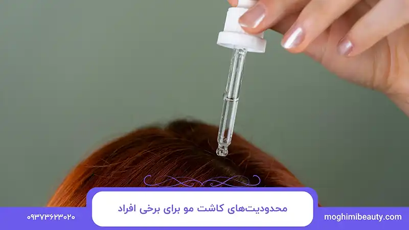 محدودیت‌های کاشت مو برای برخی افراد