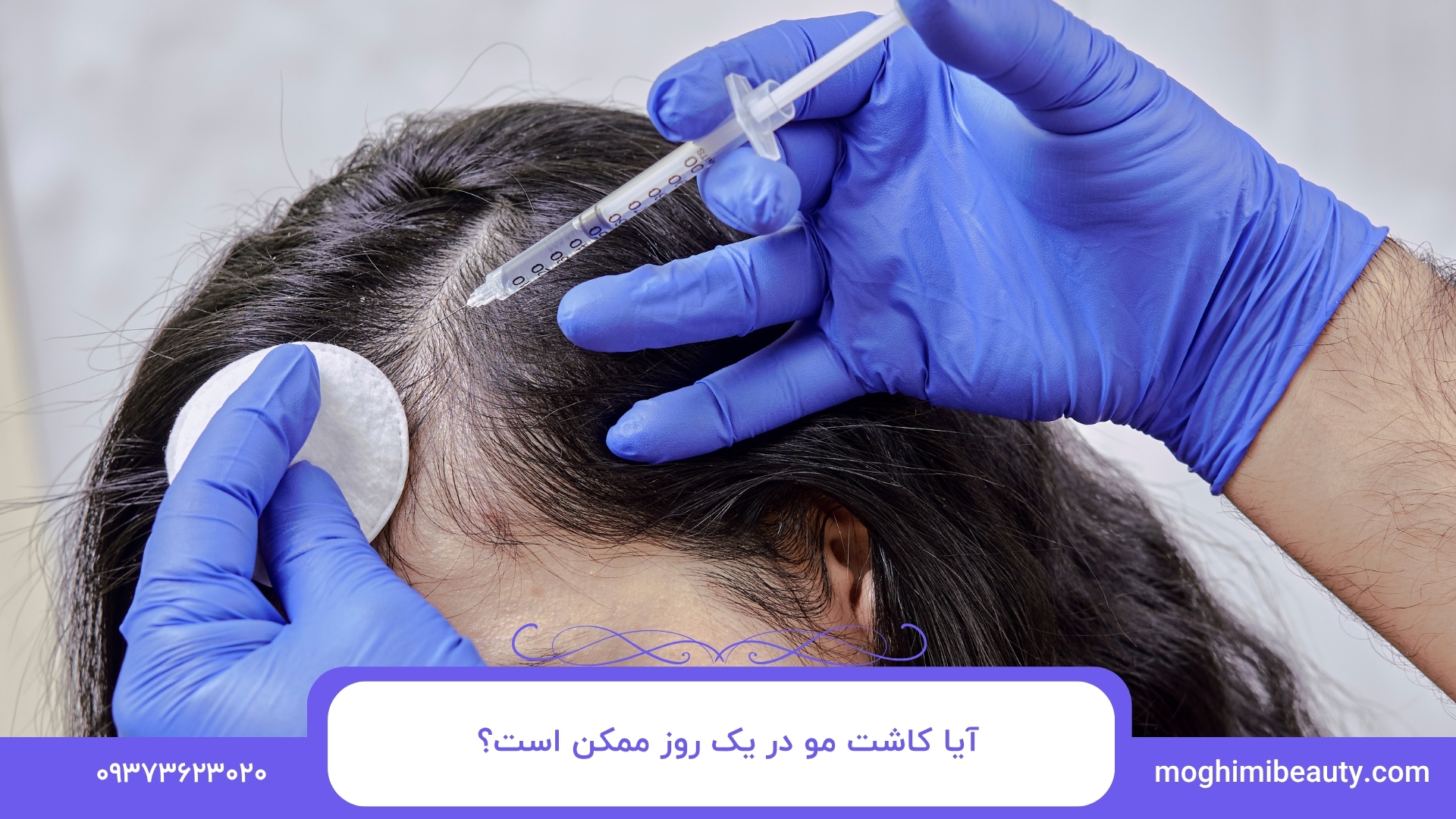 آیا کاشت مو در یک روز ممکن است؟